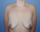 beforeBreastAug